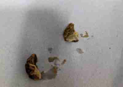 Ear wax build-up that can be treated with irrigation