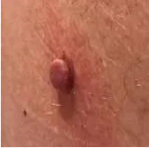 Skin tags
