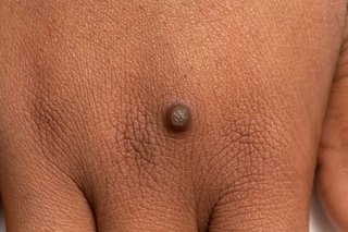 Warts